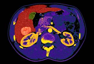 Hepatocellular carcinoma (HCC) is the fastest growing cause of cancer-related death in the United States. Hepatocellular carcinoma (HCC) is the fastest growing cause of cancer-related death in the United States.