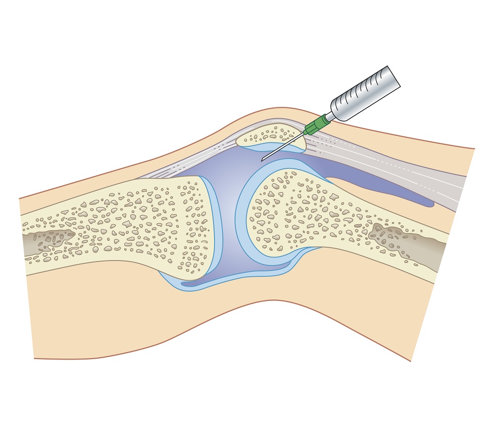 synovial-fluid-cell-counts-do-not-accurately-differentiate-arthritis-types