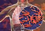 Could a New Universal Tuberculosis Regimen Help End the TB Pandemic? Could a New Universal Tuberculosis Regimen Help End the TB Pandemic?