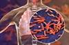 Could a New Universal Tuberculosis Regimen Help End the TB Pandemic? Could a New Universal Tuberculosis Regimen Help End the TB Pandemic?