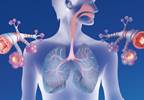 COPD Frequently Misdiagnosed, Undiagnosed in Individuals Infected With HIV COPD Frequently Misdiagnosed, Undiagnosed in Individuals Infected With HIV