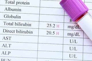 Bilirubin appeared to be inversely associated with cardiovascular disease in individuals with HIV enrolled in the Veterans Aging Cohort Study. Bilirubin appeared to be inversely associated with cardiovascular disease in individuals with HIV enrolled in the Veterans Aging Cohort Study.