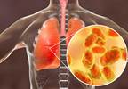 Combining Corticosteroids and Antibiotics May Be Cost-Effective in CAP Combining Corticosteroids and Antibiotics May Be Cost-Effective in CAP