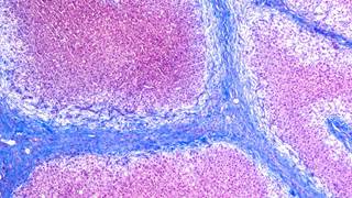 Baseline model for end-stage liver disease score >20 and multiple complications were associated with short-term mortality in decompensated cirrhosis. Baseline model for end-stage liver disease score >20 and multiple complications were associated with short-term mortality in decompensated cirrhosis.