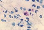 High Sensitivity, Specificity for Chlamydia Point-of-Care Test High Sensitivity, Specificity for Chlamydia Point-of-Care Test