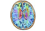 Abnormal Glucose Regulation Associated With Cognitive Dysfunction in HIV+ Men Abnormal Glucose Regulation Associated With Cognitive Dysfunction in HIV+ Men