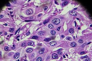 An imbalance between lymphocytes and neutrophils may be present in patients infected with HCV who develop HCC. An imbalance between lymphocytes and neutrophils may be present in patients infected with HCV who develop HCC.
