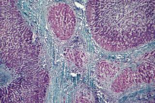 Knowing the etiology of acute liver failure is critical for effective treatment and prognosis. <i>Credit:Michael Abbey/Science Source</i> Knowing the etiology of acute liver failure is critical for effective treatment and prognosis. <i>Credit:Michael Abbey/Science Source</i>