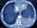 PCV13 Reduces Hospitalization for Vaccine-Type Community-Acquired Pneumonia PCV13 Reduces Hospitalization for Vaccine-Type Community-Acquired Pneumonia