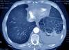 PCV13 Reduces Hospitalization for Vaccine-Type Community-Acquired Pneumonia PCV13 Reduces Hospitalization for Vaccine-Type Community-Acquired Pneumonia