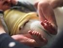 Hypertonic Saline Inhalation Safety Tested in Infants With Cystic Fibrosis Hypertonic Saline Inhalation Safety Tested in Infants With Cystic Fibrosis