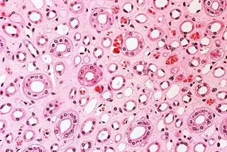 Results highlight common occurrence of AKI. Results highlight common occurrence of AKI.