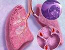 Sarcoidosis Diagnostic Score Enhances Disease Diagnosis Sarcoidosis Diagnostic Score Enhances Disease Diagnosis