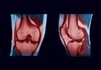 IV Drug Use Associated With Increased Mortality in Septic Arthritis IV Drug Use Associated With Increased Mortality in Septic Arthritis