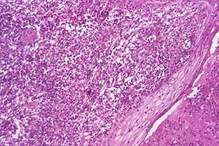Environmental remediation and proper pool maintenance helped halt the <i>Mycobacterium abscessus</i> transmission. Environmental remediation and proper pool maintenance helped halt the <i>Mycobacterium abscessus</i> transmission.