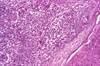 First Pediatric Outbreak of Mycobacterium abscessus Hand and Foot Disease in the United States First Pediatric Outbreak of Mycobacterium abscessus Hand and Foot Disease in the United States