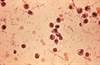 CDC Issues Update for Resistant <i>Shigella</i> Infections CDC Issues Update for Resistant <i>Shigella</i> Infections