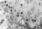 Increased Levels of Human Herpesvirus Identified in Alzheimer's Increased Levels of Human Herpesvirus Identified in Alzheimer's
