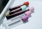 No Reduction in Antibiotic Use With Procalcitonin-Guided Therapy in the ED No Reduction in Antibiotic Use With Procalcitonin-Guided Therapy in the ED