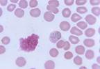 Single-Dose Tafenoquine Effective in Preventing Relapse of <i>P vivax</i> Malaria Single-Dose Tafenoquine Effective in Preventing Relapse of <i>P vivax</i> Malaria