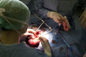 Good Outcomes for HCV-Negative Recipients of HCV Kidneys Good Outcomes for HCV-Negative Recipients of HCV Kidneys