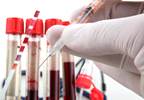 Effect of Dengue Serostatus on Dengue Vaccine Safety and Efficacy Effect of Dengue Serostatus on Dengue Vaccine Safety and Efficacy