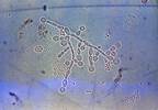 Novel Nanodiagnostic Panel May Reduce Empiric Antifungal Use in High-Risk Candidemia Novel Nanodiagnostic Panel May Reduce Empiric Antifungal Use in High-Risk Candidemia