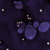 HPV-Associated Neoplasms and Other Lesions in Human Immunodeficiency Virus Infection HPV-Associated Neoplasms and Other Lesions in Human Immunodeficiency Virus Infection