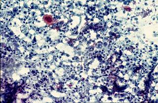 A mail-based HPV self-testing program appears to be a promising approach to screening women in Appalachia. <i>Photo Credit: Medical Images/ISM/Dr. A Gaillot</i> A mail-based HPV self-testing program appears to be a promising approach to screening women in Appalachia. <i>Photo Credit: Medical Images/ISM/Dr. A Gaillot</i>