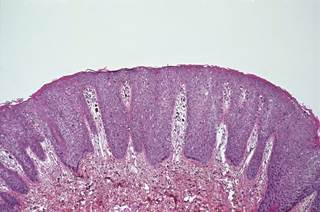 Hispanics with HIV have an increased risk for HPV-related cancers than Hispanics in the general population. Hispanics with HIV have an increased risk for HPV-related cancers than Hispanics in the general population.