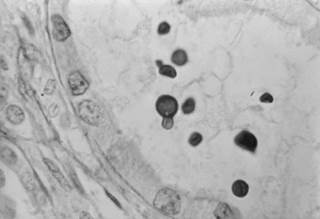 Pre-emptive fluconazole treatment following screening to exclude cryptococcal meningitis may increase survival in CrAg-positive, asymptomatic patients with HIV. <i>Photo Credit: CDC/ Dr. Lucille G</i> Pre-emptive fluconazole treatment following screening to exclude cryptococcal meningitis may increase survival in CrAg-positive, asymptomatic patients with HIV. <i>Photo Credit: CDC/ Dr. Lucille G</i>