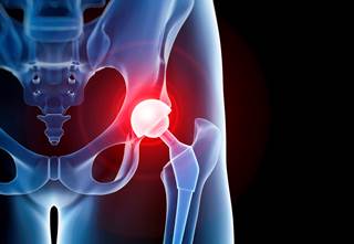 Several modifiable and nonmodifiable factors are associated with the risk for revision for prosthetic joint infection. Several modifiable and nonmodifiable factors are associated with the risk for revision for prosthetic joint infection.
