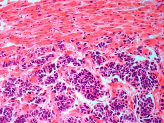 Preventive therapy against HBV reactivation is recommended for patients with hepatocellular carcinoma who are scheduled to receive radiotherapy. Preventive therapy against HBV reactivation is recommended for patients with hepatocellular carcinoma who are scheduled to receive radiotherapy.