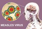 Decline of Subacute Sclerosing Panencephalitis Mortality Linked With Increased Vaccinations Decline of Subacute Sclerosing Panencephalitis Mortality Linked With Increased Vaccinations