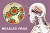 Decline of Subacute Sclerosing Panencephalitis Mortality Linked With Increased Vaccinations Decline of Subacute Sclerosing Panencephalitis Mortality Linked With Increased Vaccinations