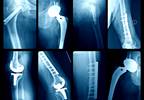 Individualized Treatment of Late Acute Prosthetic Joint Infection May Decrease Failure Rate Individualized Treatment of Late Acute Prosthetic Joint Infection May Decrease Failure Rate