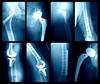 Individualized Treatment of Late Acute Prosthetic Joint Infection May Decrease Failure Rate Individualized Treatment of Late Acute Prosthetic Joint Infection May Decrease Failure Rate