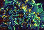 HIV & Cancer Risk: Expert Interview HIV & Cancer Risk: Expert Interview