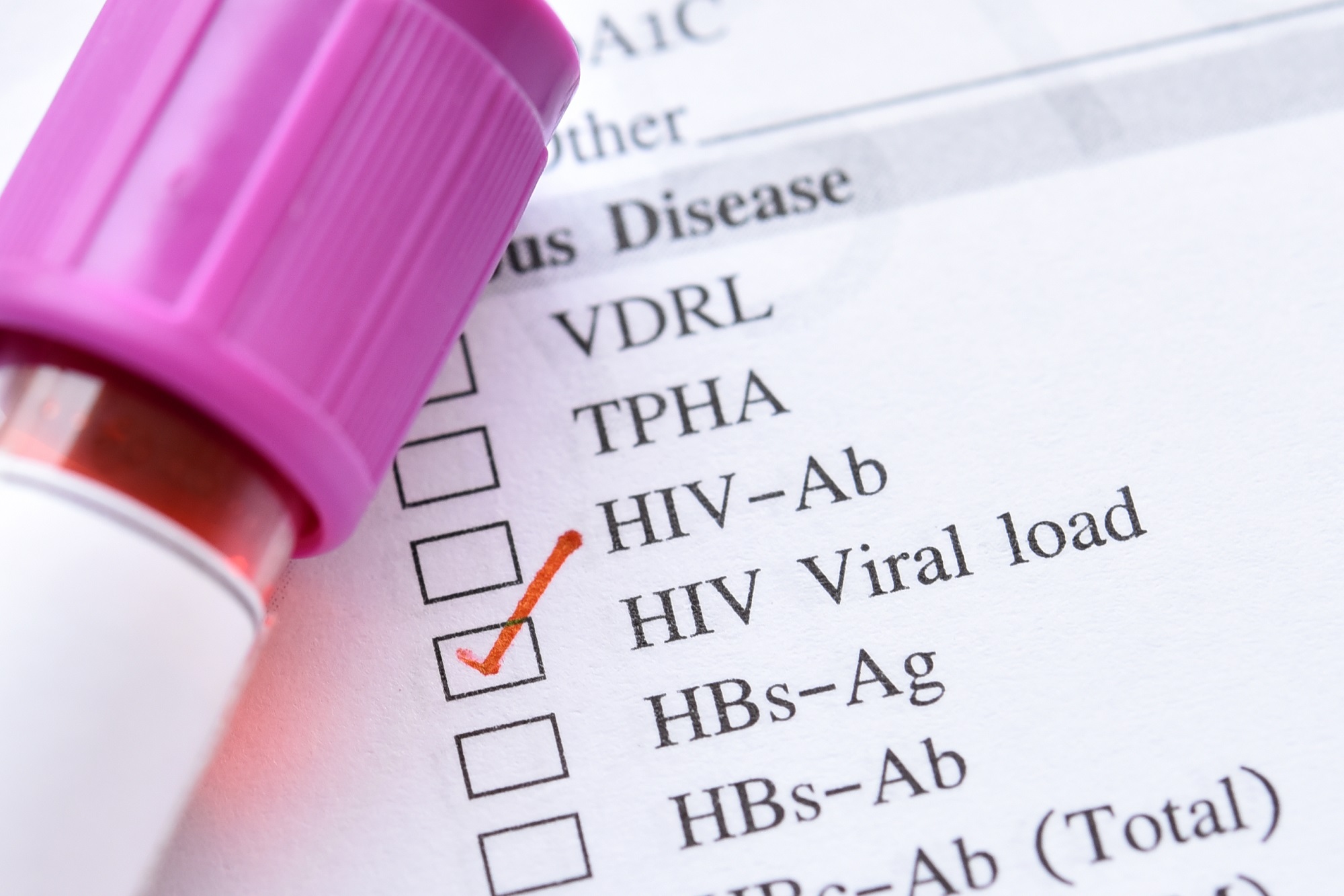 early-diagnosis-of-hiv-linked-with-higher-viral-loads-than-later-diagnosis