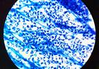 Tuberculosis Assessment More Efficient With Sputum Molecular Testing Tuberculosis Assessment More Efficient With Sputum Molecular Testing
