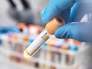 A major challenge associated with hepatitis screening is the loss to follow-up that occurs in people who inject drugs. A major challenge associated with hepatitis screening is the loss to follow-up that occurs in people who inject drugs.