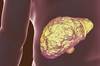 Noninvasive Biomarker of Variceal Bleeding in HCV Cirrhosis Noninvasive Biomarker of Variceal Bleeding in HCV Cirrhosis