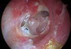 Short-Course Oral Steroids Ineffective for Pediatric Otitis Media With Effusion Short-Course Oral Steroids Ineffective for Pediatric Otitis Media With Effusion