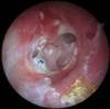 Short-Course Oral Steroids Ineffective for Pediatric Otitis Media With Effusion Short-Course Oral Steroids Ineffective for Pediatric Otitis Media With Effusion