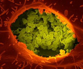 New complications identified included acute Q fever endocarditis, hemophagocytic syndrome, thrombosis, lymphadenitis, and lymphoma. New complications identified included acute Q fever endocarditis, hemophagocytic syndrome, thrombosis, lymphadenitis, and lymphoma.