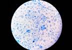 Patient Develops Rare Extrapulmonary Manifestation of Tuberculosis Patient Develops Rare Extrapulmonary Manifestation of Tuberculosis