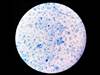 Patient Develops Rare Extrapulmonary Manifestation of Tuberculosis Patient Develops Rare Extrapulmonary Manifestation of Tuberculosis