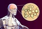 Cryptococcal Meningitis May Be Linked With Higher Mortality in PLWHIV Cryptococcal Meningitis May Be Linked With Higher Mortality in PLWHIV