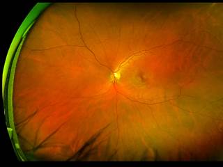 Patients with AIDS-related CMV retinitis receiving cART, but not specific anti-CMV therapy, were found to have active retinitis. Patients with AIDS-related CMV retinitis receiving cART, but not specific anti-CMV therapy, were found to have active retinitis.