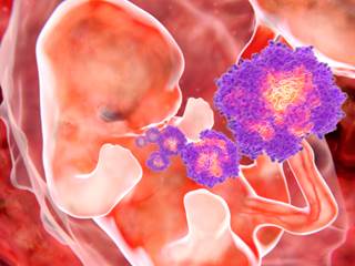 In one of the first detailed analyses of a CZS case, investigators demonstrate the presence of Zika viral RNA in the spleen, lungs, liver and muscle. In one of the first detailed analyses of a CZS case, investigators demonstrate the presence of Zika viral RNA in the spleen, lungs, liver and muscle.
